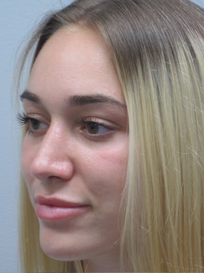 Rhinoplasty Before & After Gallery - Patient 11109881 - Image 6