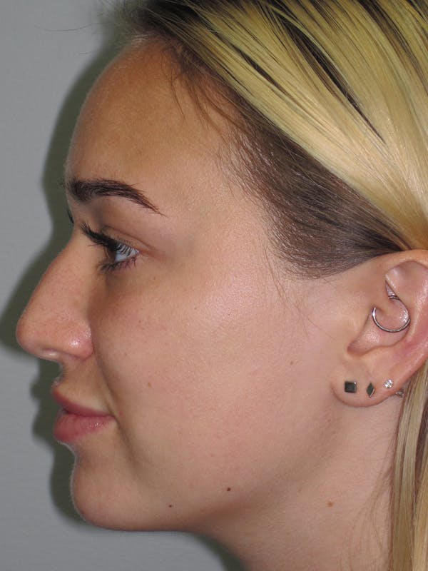 Rhinoplasty Before & After Gallery - Patient 11109881 - Image 7