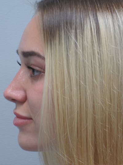 Rhinoplasty Before & After Gallery - Patient 11109881 - Image 8