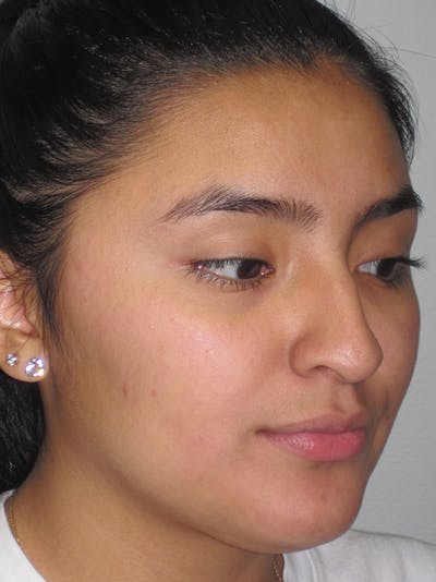 Rhinoplasty Before & After Gallery - Patient 11109883 - Image 1