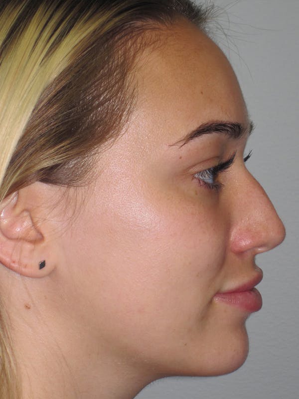 Rhinoplasty Before & After Gallery - Patient 11109881 - Image 1