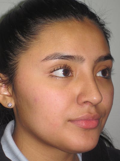 Rhinoplasty Before & After Gallery - Patient 11109883 - Image 2