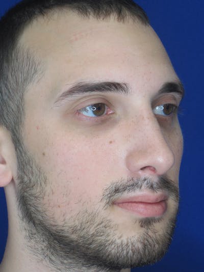 Rhinoplasty Before & After Gallery - Patient 11109882 - Image 4