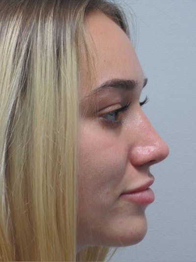 Rhinoplasty Before & After Gallery - Patient 11109881 - Image 2