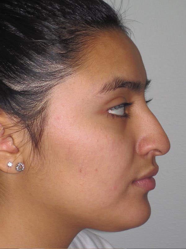 Rhinoplasty Before & After Gallery - Patient 11109883 - Image 3