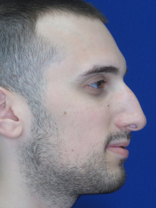 Rhinoplasty Before & After Gallery - Patient 11109882 - Image 1