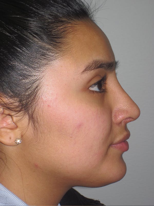 Rhinoplasty Before & After Gallery - Patient 11109883 - Image 4
