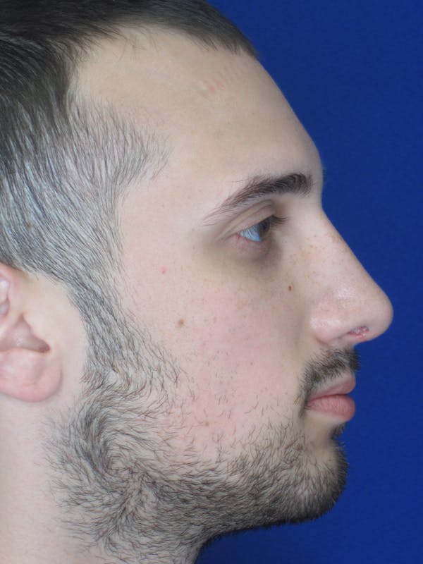 Rhinoplasty Before & After Gallery - Patient 11109882 - Image 2