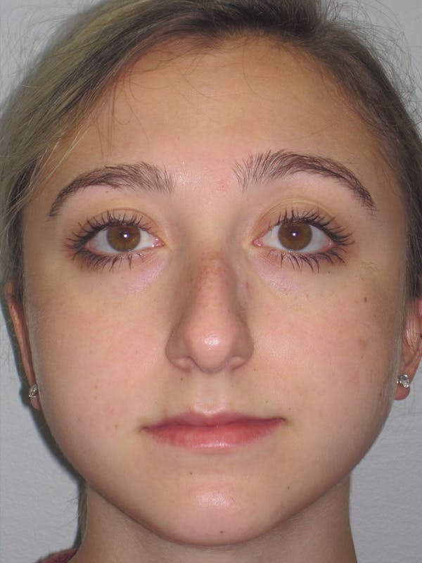 Rhinoplasty Before & After Gallery - Patient 11109884 - Image 3