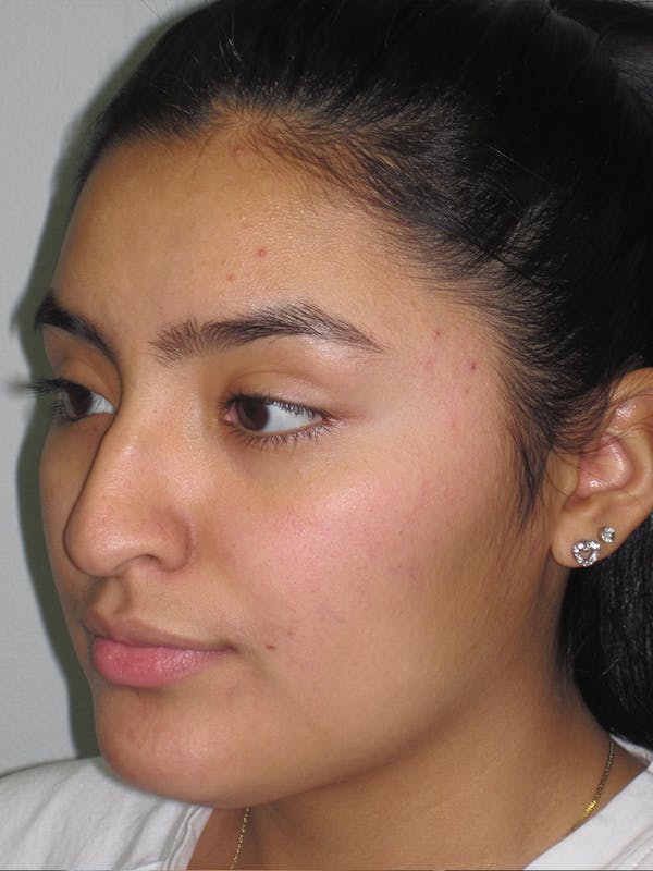 Rhinoplasty Before & After Gallery - Patient 11109883 - Image 5