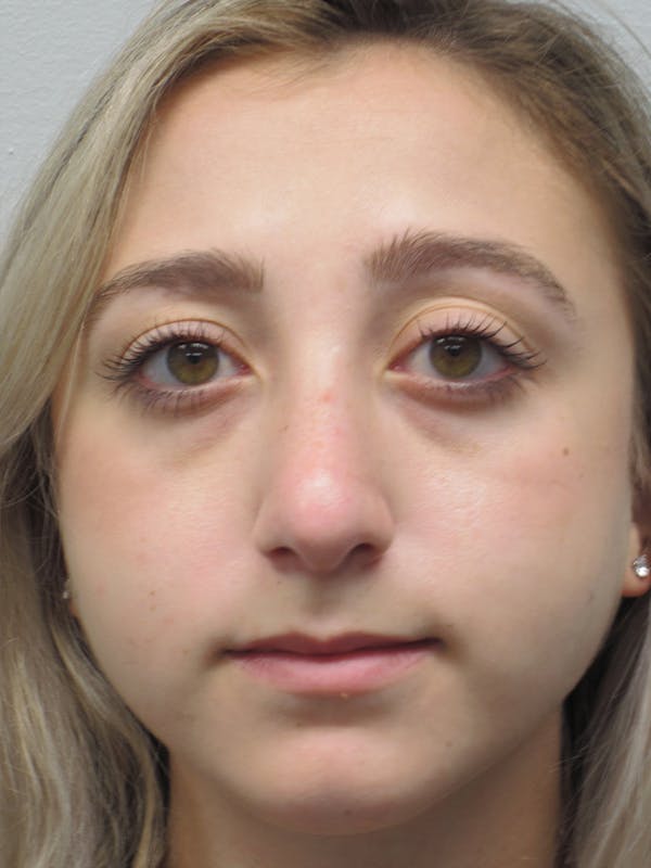 Rhinoplasty Before & After Gallery - Patient 11109884 - Image 4