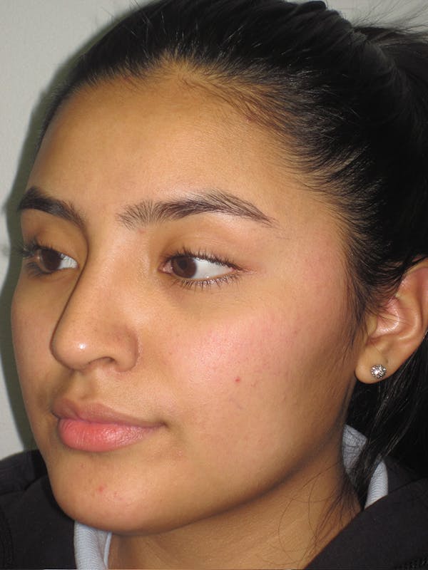 Rhinoplasty Before & After Gallery - Patient 11109883 - Image 6