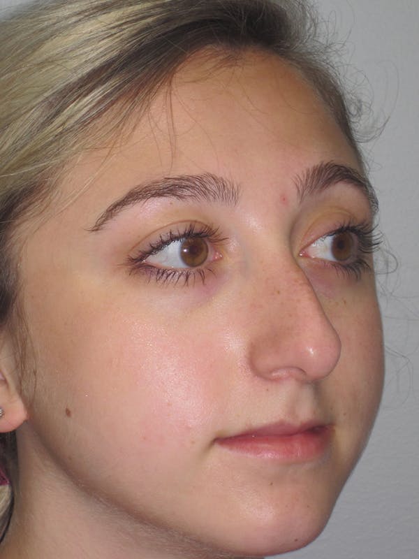 Rhinoplasty Before & After Gallery - Patient 11109884 - Image 5