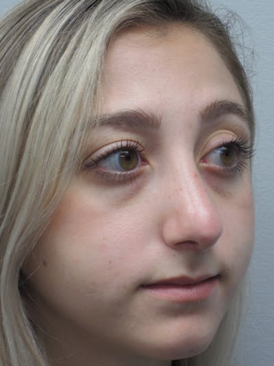 Rhinoplasty Before & After Gallery - Patient 11109884 - Image 6