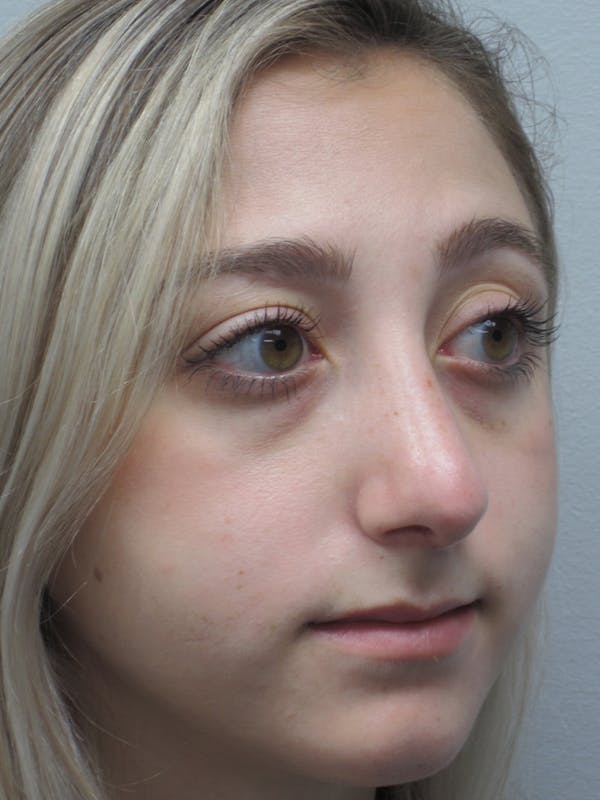 Rhinoplasty Before & After Gallery - Patient 11109884 - Image 6