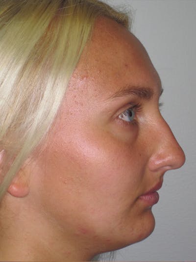 Rhinoplasty Before & After Gallery - Patient 11109885 - Image 1