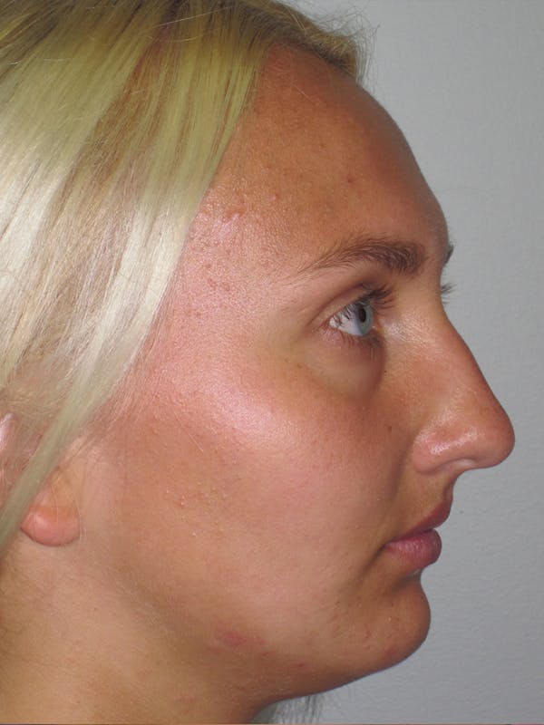 Rhinoplasty Before & After Gallery - Patient 11109885 - Image 1