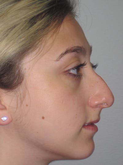 Rhinoplasty Before & After Gallery - Patient 11109884 - Image 1