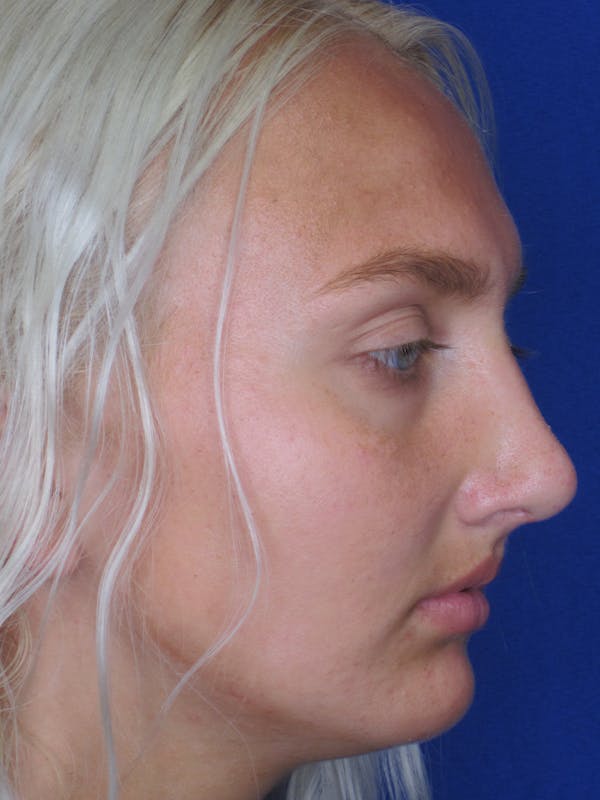 Rhinoplasty Before & After Gallery - Patient 11109885 - Image 2
