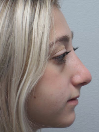 Rhinoplasty Before & After Gallery - Patient 11109884 - Image 2