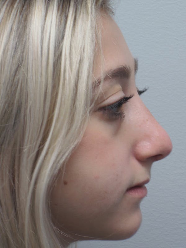 Rhinoplasty Gallery - Patient 11109884 - Image 2