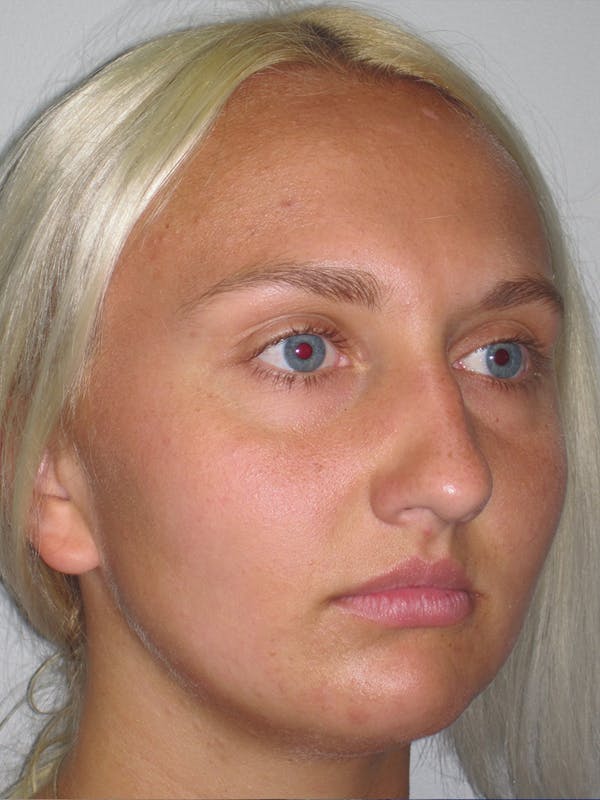 Rhinoplasty Before & After Gallery - Patient 11109885 - Image 3