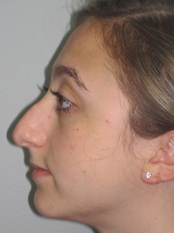 Rhinoplasty Before & After Gallery - Patient 11109884 - Image 7