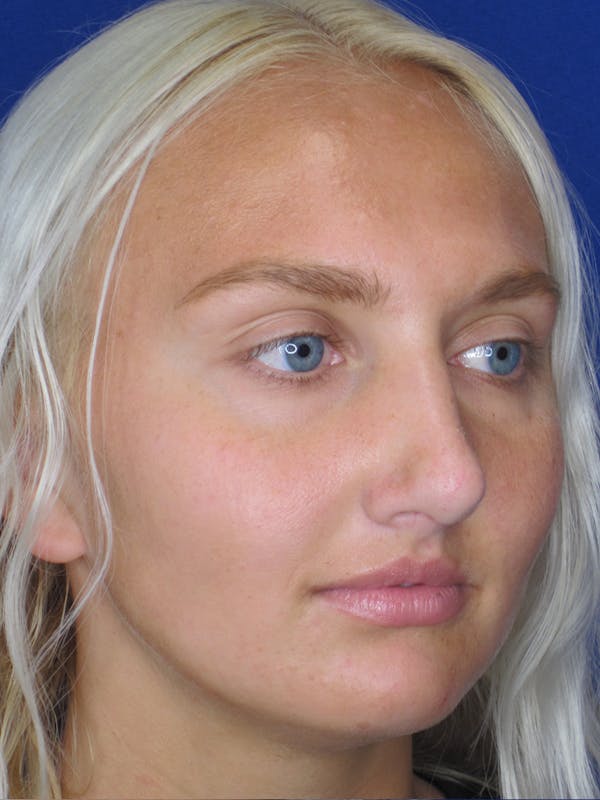 Rhinoplasty Before & After Gallery - Patient 11109885 - Image 4