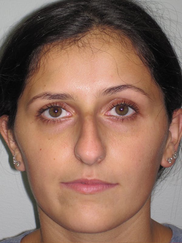 Rhinoplasty Before & After Gallery - Patient 11109886 - Image 3
