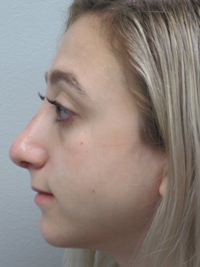 Rhinoplasty Before & After Gallery - Patient 11109884 - Image 8