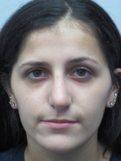 Rhinoplasty Before & After Gallery - Patient 11109886 - Image 4