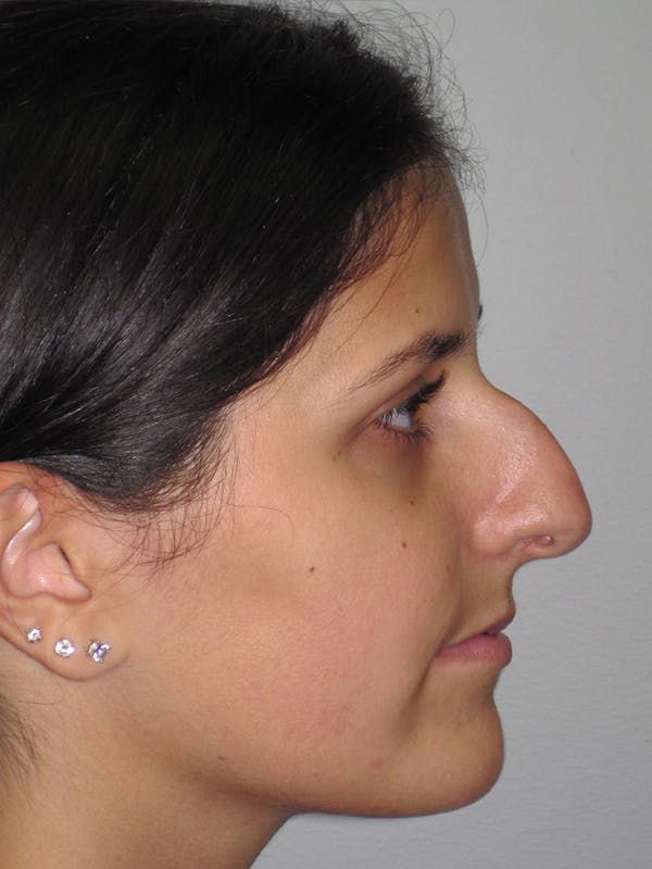 Rhinoplasty Before & After Gallery - Patient 11109886 - Image 5
