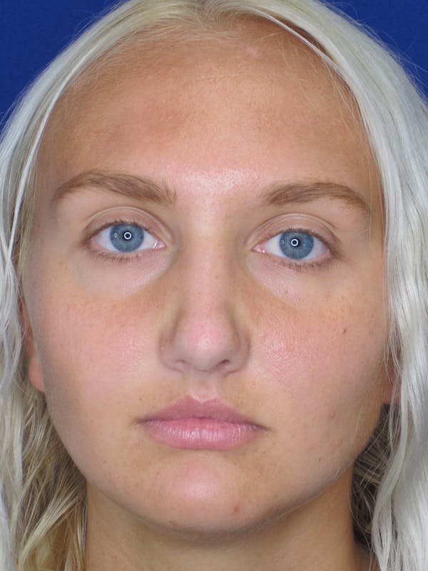 Rhinoplasty Before & After Gallery - Patient 11109885 - Image 6