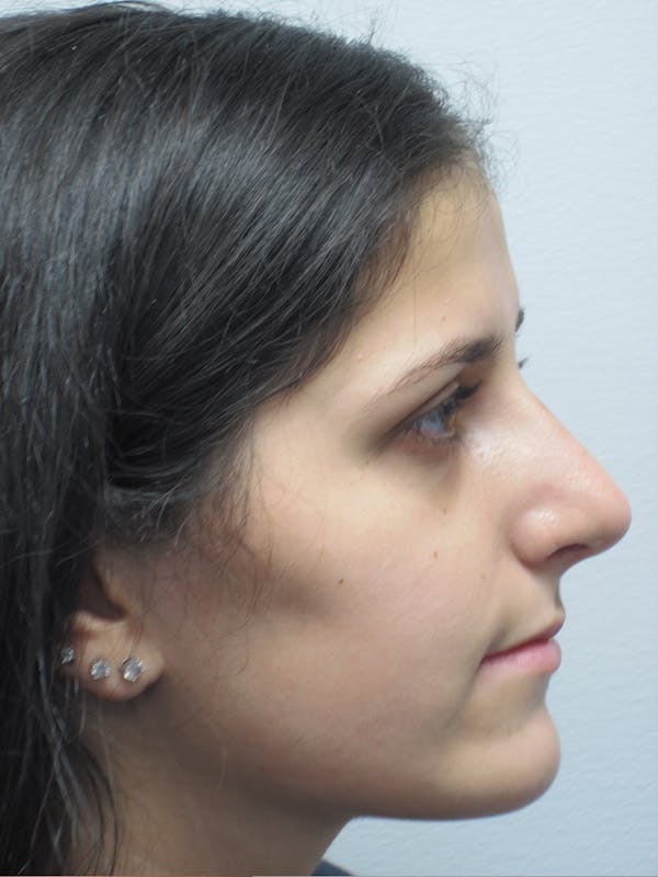 Rhinoplasty Before & After Gallery - Patient 11109886 - Image 6
