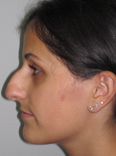 Rhinoplasty Before & After Gallery - Patient 11109886 - Image 1