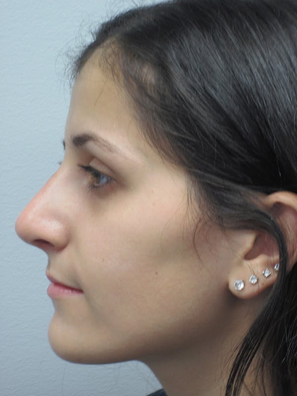 Rhinoplasty Before & After Gallery - Patient 11109886 - Image 2