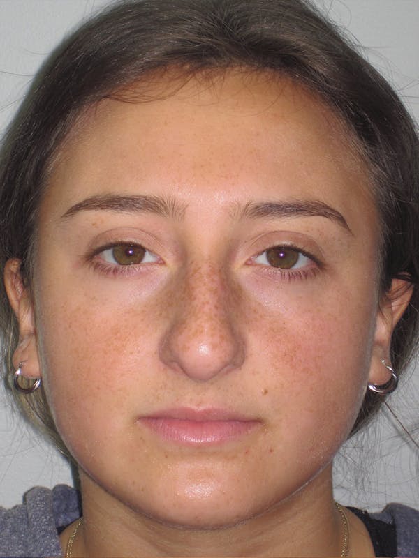 Rhinoplasty Before & After Gallery - Patient 11109910 - Image 3