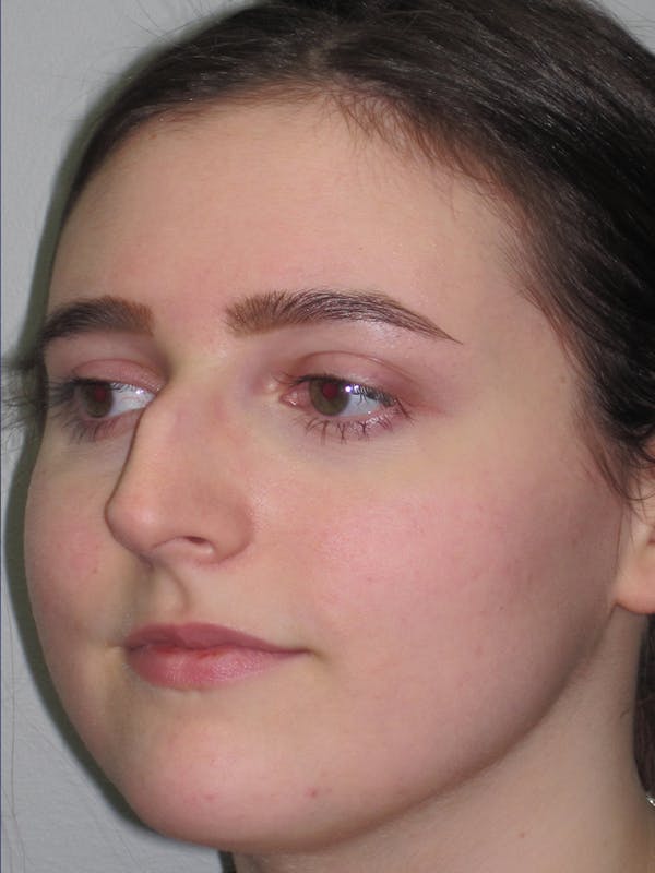 Rhinoplasty Before & After Gallery - Patient 11109911 - Image 7
