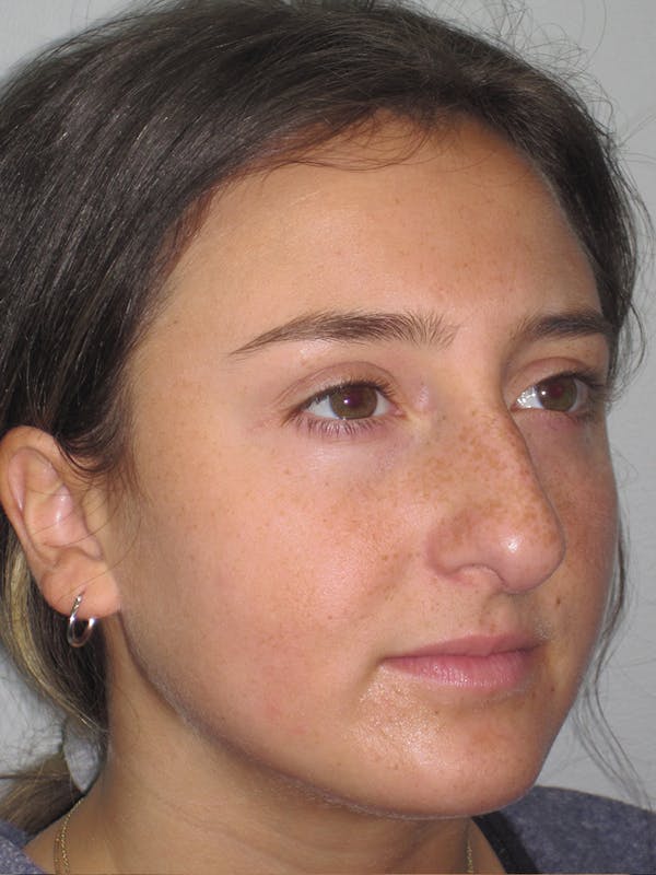 Rhinoplasty Before & After Gallery - Patient 11109910 - Image 5