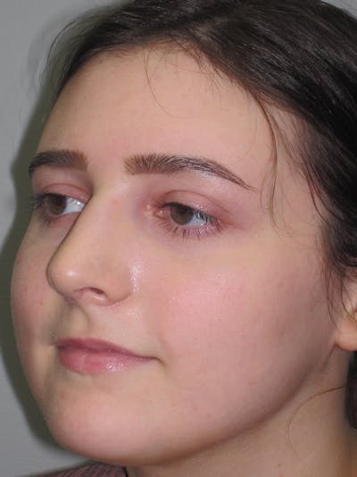 Rhinoplasty Before & After Gallery - Patient 11109911 - Image 8