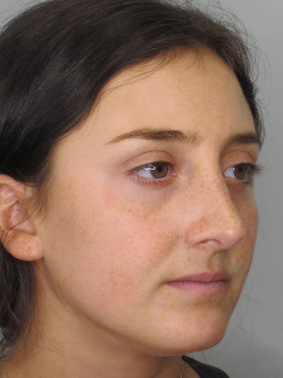 Rhinoplasty Before & After Gallery - Patient 11109910 - Image 6