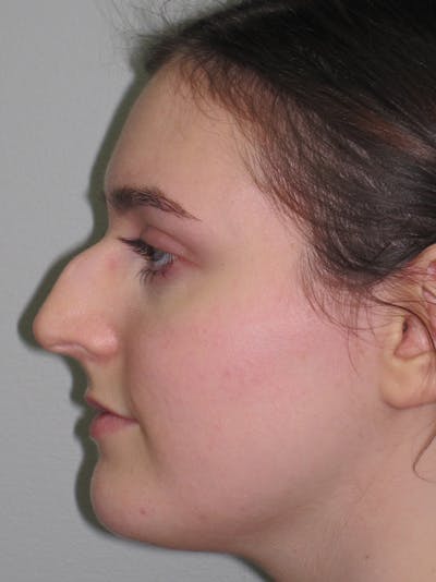 Rhinoplasty Before & After Gallery - Patient 11109911 - Image 1