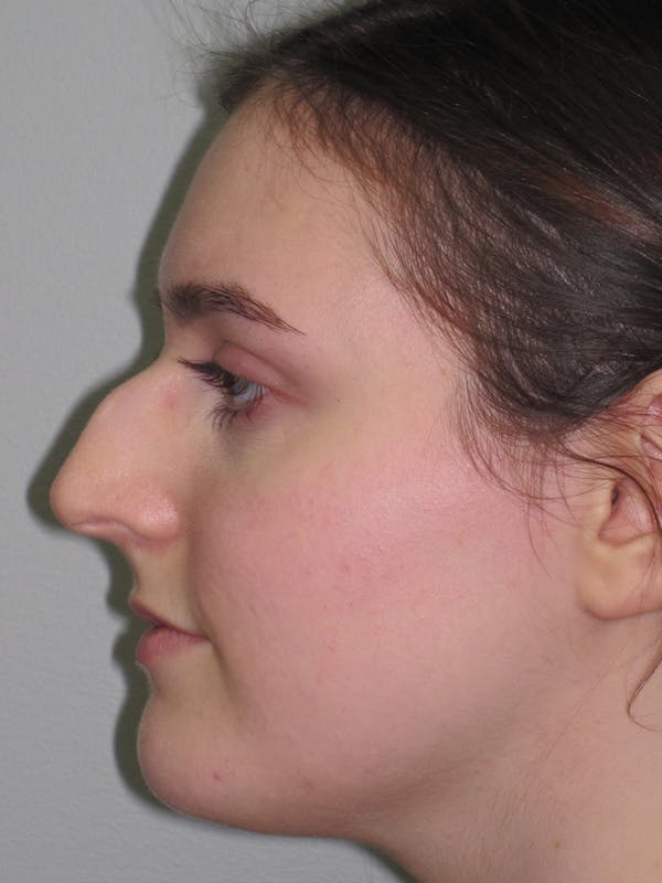 Rhinoplasty Before & After Gallery - Patient 11109911 - Image 1