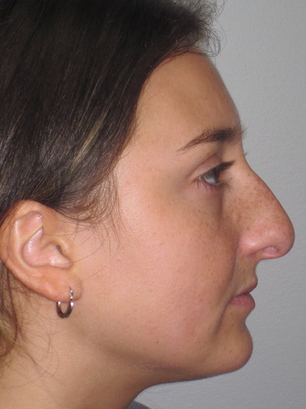 Rhinoplasty Before & After Gallery - Patient 11109910 - Image 1