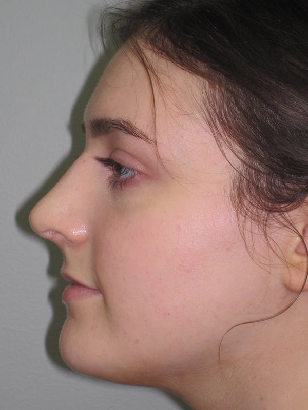 Rhinoplasty Before & After Gallery - Patient 11109911 - Image 2
