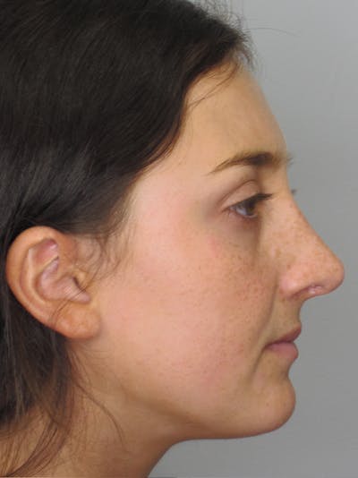 Rhinoplasty Before & After Gallery - Patient 11109910 - Image 2