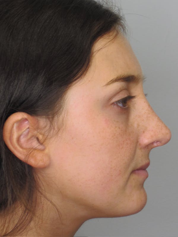 Rhinoplasty Before & After Gallery - Patient 11109910 - Image 2