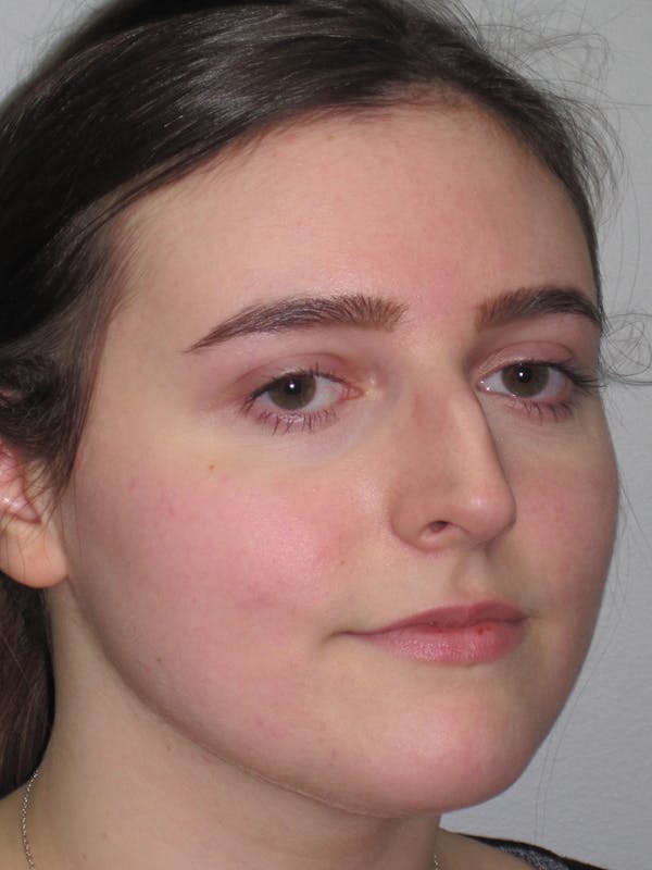 Rhinoplasty Before & After Gallery - Patient 11109911 - Image 3