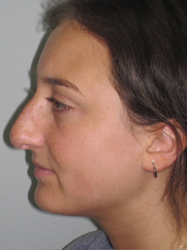 Rhinoplasty Before & After Gallery - Patient 11109910 - Image 7