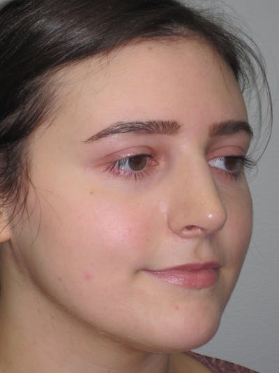 Rhinoplasty Before & After Gallery - Patient 11109911 - Image 4